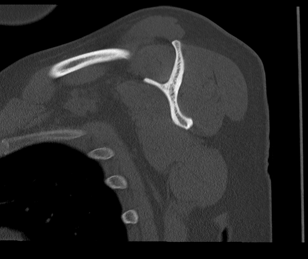 Bony Bankart and Hill-Sachs lesions (Radiopaedia 33622-34727 Sagittal bone window 40).png