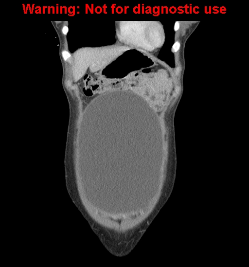 Borderline mucinous cystadenoma of ovary (Radiopaedia 25586-25767 B 8).jpg