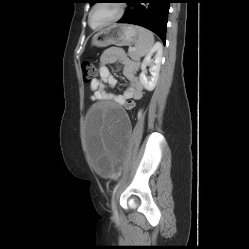 File:Borderline mucinous tumor (ovary) (Radiopaedia 78228-90808 B 47).jpg