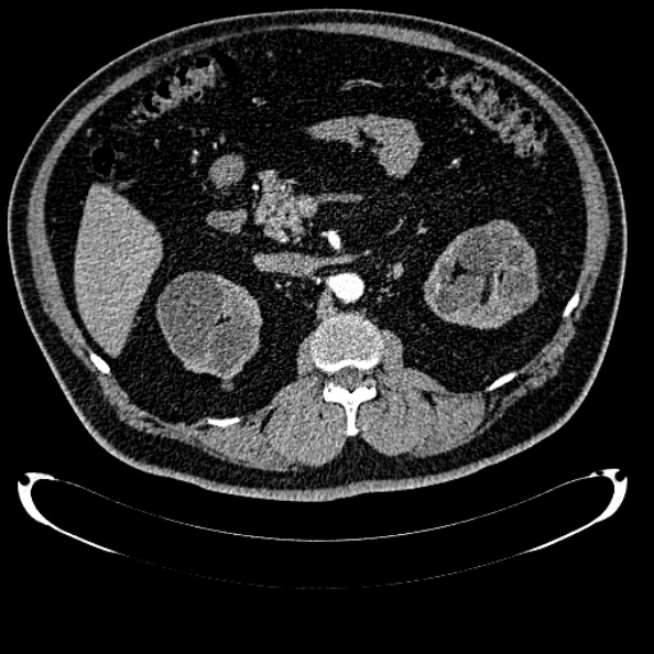 Bosniak renal cyst - type IV (Radiopaedia 24244-24518 B 125).jpg