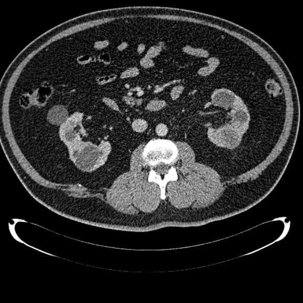 Bosniak renal cyst - type IV (Radiopaedia 24244-24518 C 174).jpg