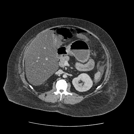 Bowel and splenic infarcts in acute lymphocytic leukemia (Radiopaedia 61055-68915 A 57).jpg