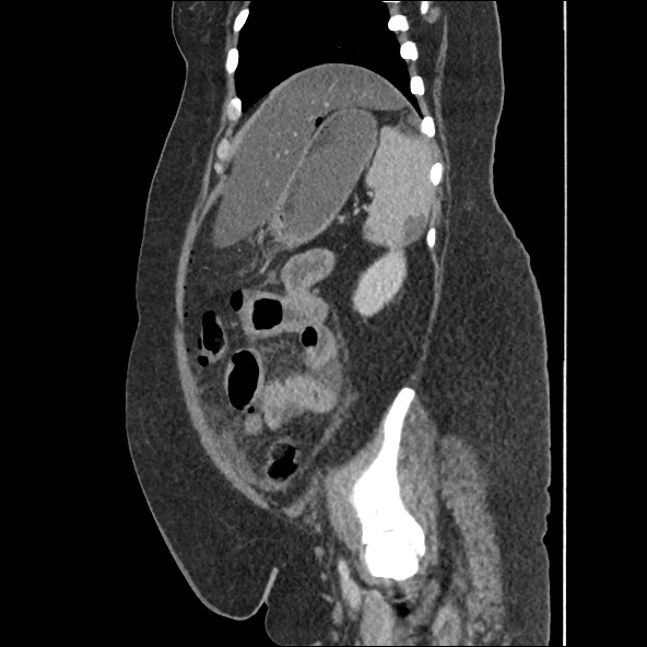 Bowel and splenic infarcts in acute lymphocytic leukemia (Radiopaedia 61055-68915 C 19).jpg