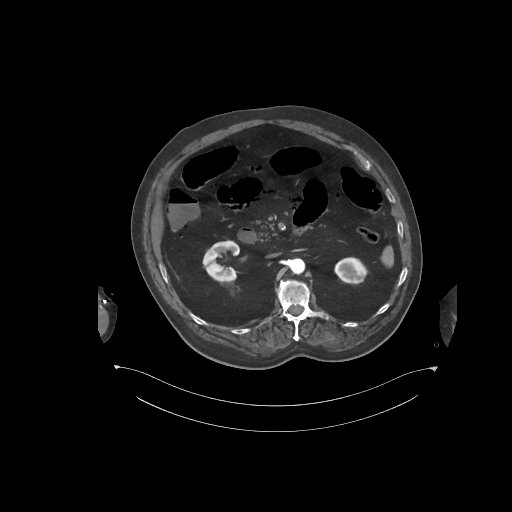 File:Bowel ischemia secondary to SMA occlusion with extensive portomesenteric venous gas (Radiopaedia 54656-60871 A 47).jpg