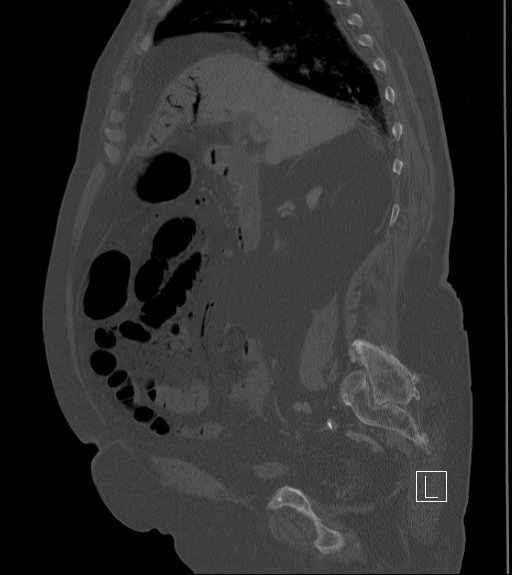 Bowel ischemia secondary to SMA occlusion with extensive portomesenteric venous gas (Radiopaedia 54656-60871 Sagittal bone window 70).jpg