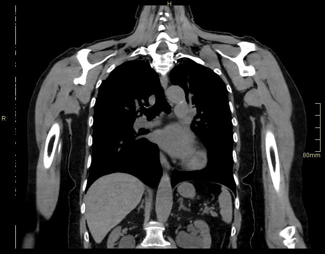 Brachial artery foreign body (Radiopaedia 54583-60820 Coronal non-contrast 32).jpg