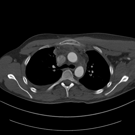Brachiocephalic trunk pseudoaneurysm (Radiopaedia 70978-81191 Axial bone window 68).jpg