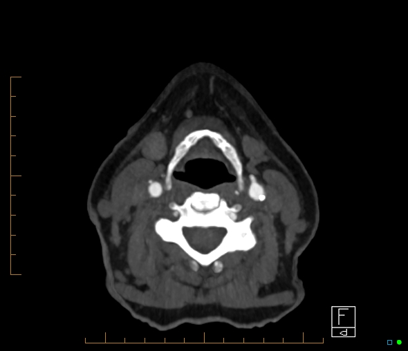 Brachiocephalic trunk stenosis (Radiopaedia 87242-103519 A 97).jpg