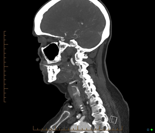Brachiocephalic trunk stenosis (Radiopaedia 87242-103519 C 25).jpg