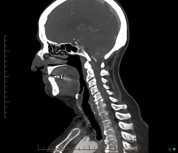 Brachiocephalic trunk stenosis (Radiopaedia 87242-103519 C 31).jpg