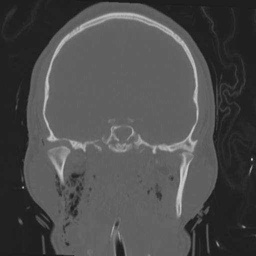 File:Brain contusions, internal carotid artery dissection and base of skull fracture (Radiopaedia 34089-35339 Coronal bone window 35).png