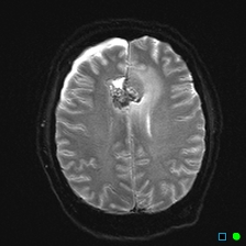 File:Brain death on MRI and CT angiography (Radiopaedia 42560-45689 Axial ADC 22).jpg