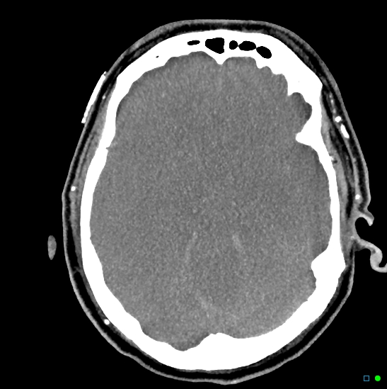 Brain death on MRI and CT angiography (Radiopaedia 42560-45841 B 31).jpg