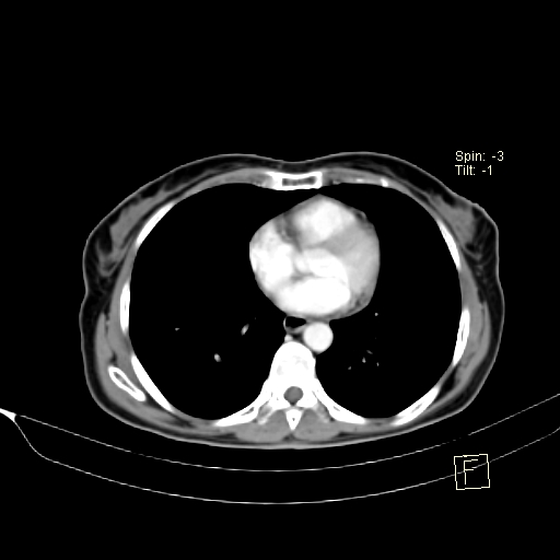 Brain metastasis as initial presentation of non-small cell lung cancer (Radiopaedia 65122-74127 A 30).jpg