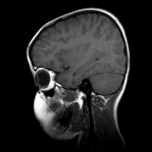 File:Brainstem ganglioglioma (Radiopaedia 10763-11224 Sagittal T1 6).jpg