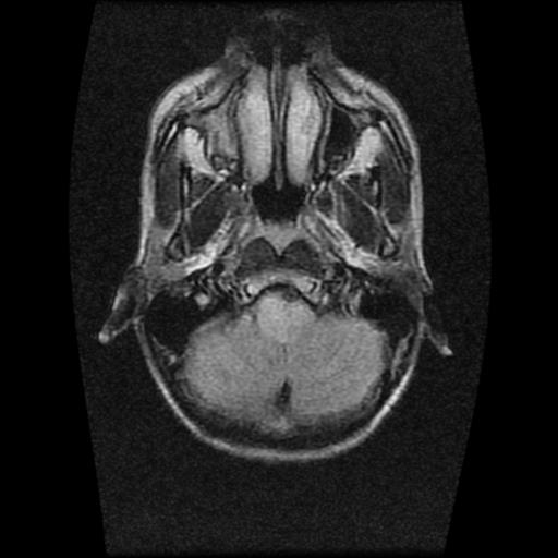 File:Brainstem glioma (Radiopaedia 30923-31624 Axial FLAIR 3).jpg