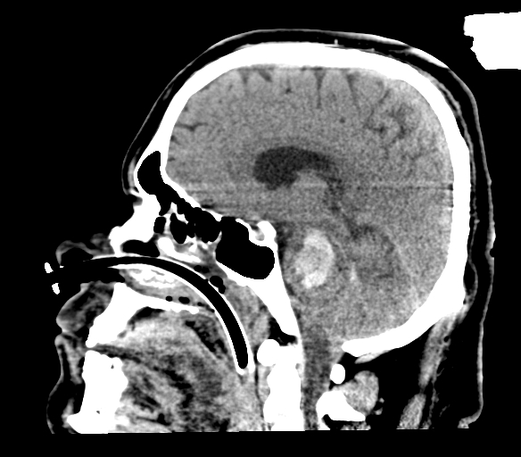 Brainstem hemorrhage (Radiopaedia 81294-94976 C 31).jpg