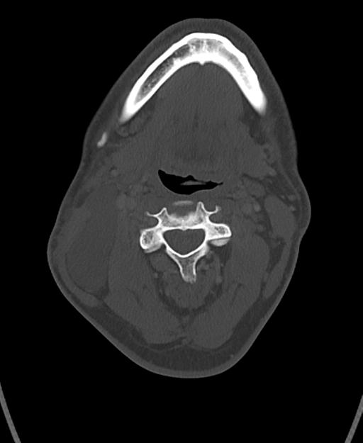 Branchial cleft cyst (Radiopaedia 31167-31875 Axial bone window 31).jpg
