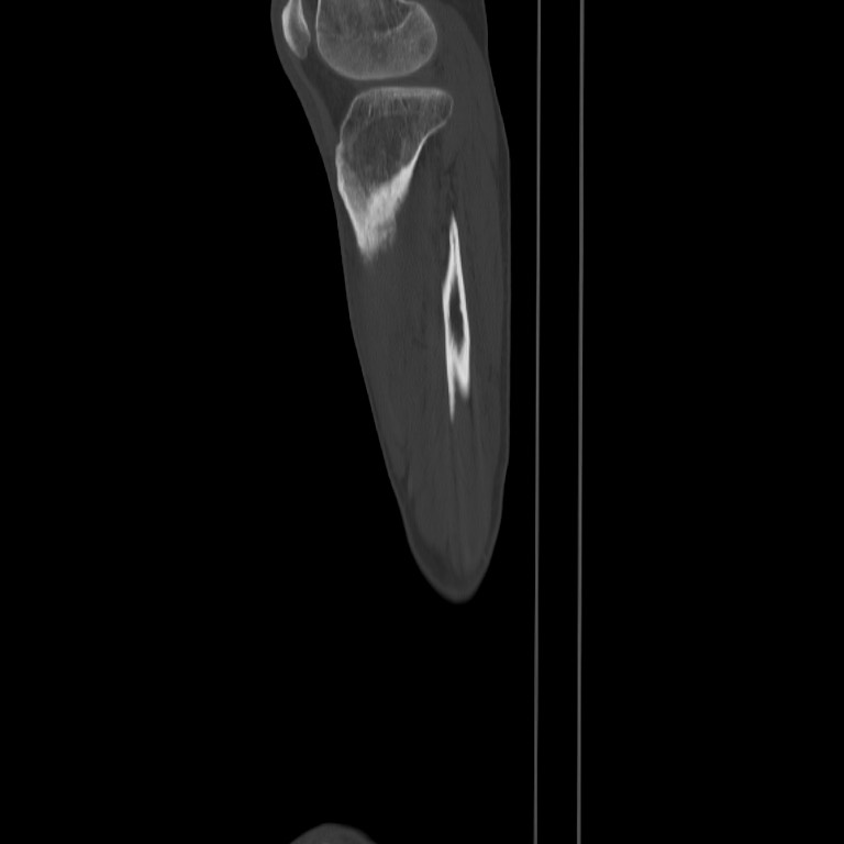 Brodie abscess - tibia (Radiopaedia 66028-75204 Sagittal bone window 65).jpg