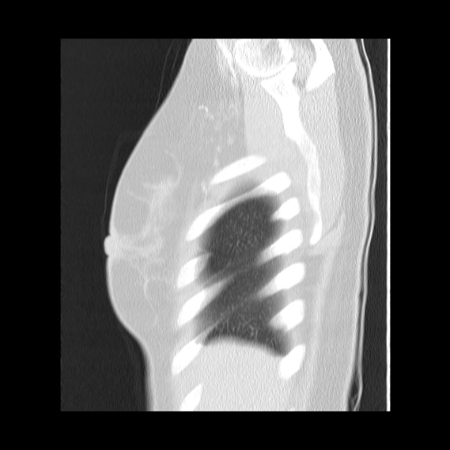 Bronchial atresia (Radiopaedia 22965-22992 Sagittal lung window 50).jpg