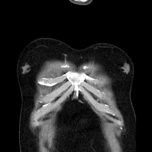 Bronchial carcinoid tumor (Radiopaedia 67377-76764 C 15).jpg