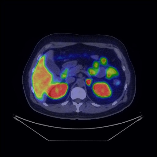 Bronchial carcinoid tumor (Radiopaedia 67377-76765 68Ga-DOTATATE PET-CT 45).jpg