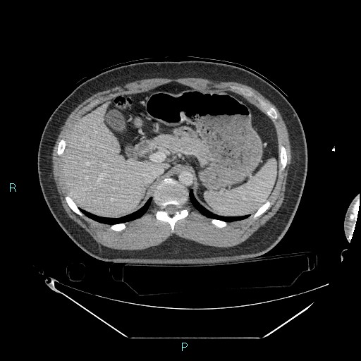 File:Bronchial carcinoid tumor (Radiopaedia 78272-90870 C 122).jpg
