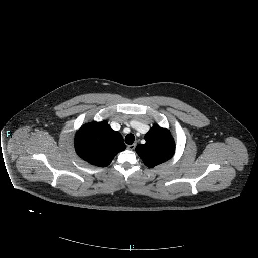 Bronchial carcinoid tumor (Radiopaedia 78272-90875 A 23).jpg