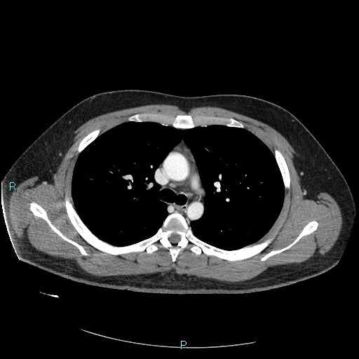 Bronchial carcinoid tumor (Radiopaedia 78272-90875 A 40).jpg