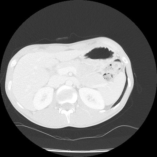 Bronchial carcinoid tumor causing right lower lobe collapse (Radiopaedia 83495-98594 Axial lung window 58).jpg