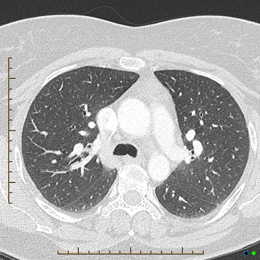 File:Bronchial diverticula (Radiopaedia 79512-92676 Axial lung window 66).jpg