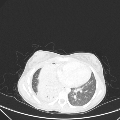 Bronchial mucoepidermoid carcinoma (Radiopaedia 57023-63895 Axial lung window 72).jpg