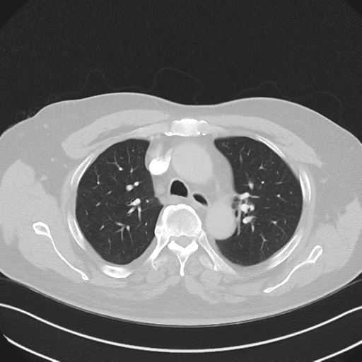 Bronchiectasis (Radiopaedia 39385-41666 Axial lung window 22).png
