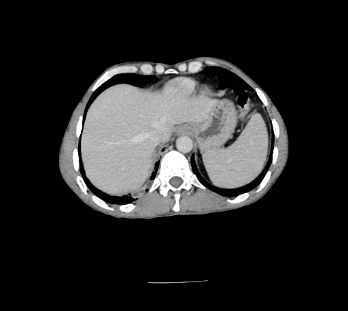 File:Bronchiectasis in Crohn disease (Radiopaedia 60311-67977 B 24).jpg