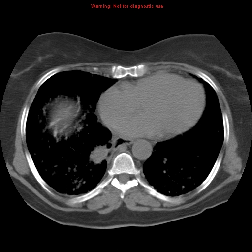 Bronchoalveolar carcinoma (Radiopaedia 13224-13233 Axial non-contrast 30).jpg