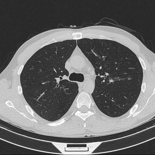 Bronchocele (Radiopaedia 60676-68429 Axial lung window 25).jpg