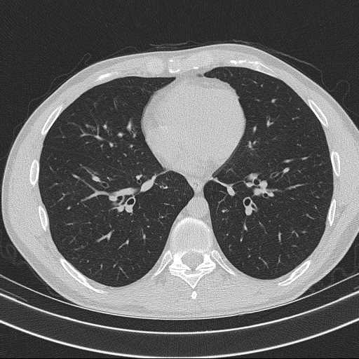Bronchocele (Radiopaedia 60676-68429 Axial lung window 46).jpg