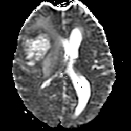 File:Bronchogenic carcinoma brain metastasis (Radiopaedia 9286-9969 Axial ADC 1).jpg