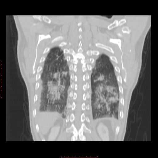 File:Bronchogenic carcinoma with left atrial large deposit - T4N3M1a (Radiopaedia 42316-45428 Coronal lung window 15).jpg