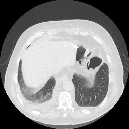 Bronchogenic carcinoma with metastatic lymphadenopathy (Radiopaedia 37671-39569 Axial lung window 45).jpg