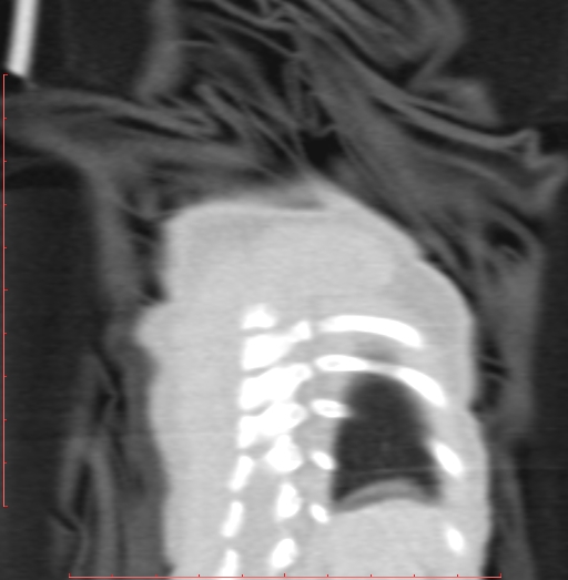 Bronchogenic cyst (Radiopaedia 78599-91409 Coronal lung window 212).jpg