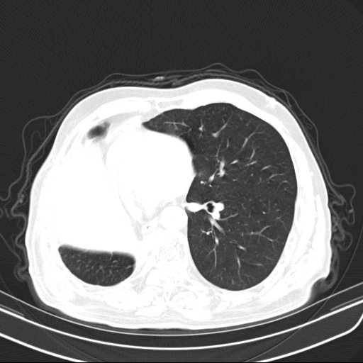 File:Bronchopleural fistula - postoperative complication (Radiopaedia 21020-20947 Axial lung window 34).jpg