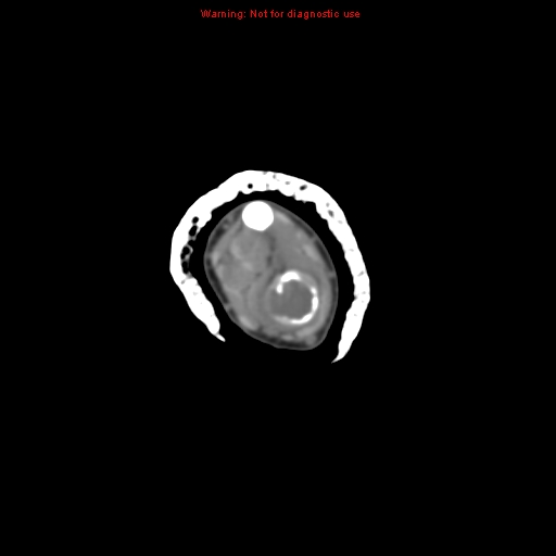 File:Brown tumor (Radiopaedia 12460-12694 Axial non-contrast 50).jpg
