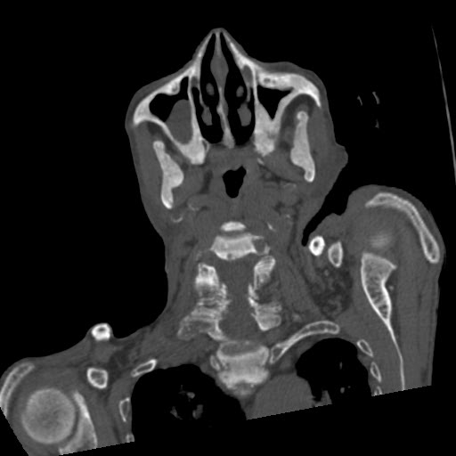 File:Brown tumor with secondary hyperparathyroidism (Radiopaedia 23591-23705 C 29).jpg