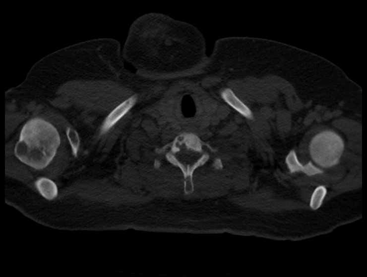 Brown tumors compressing the spinal cord (Radiopaedia 68442-77988 Axial bone window 2).jpg