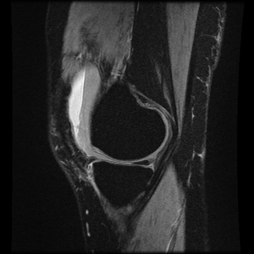 Bucket handle meniscus tear (Radiopaedia 56916-63751 H 62).jpg