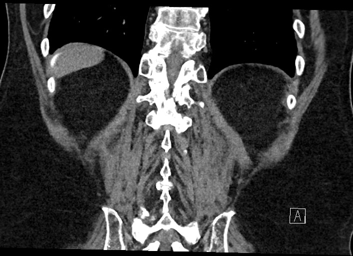 Buried bumper syndrome - gastrostomy tube (Radiopaedia 63843-72577 Coronal Inject 115).jpg