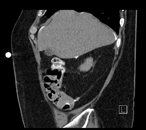 Buried bumper syndrome - gastrostomy tube (Radiopaedia 63843-72577 Sagittal Inject 99).jpg