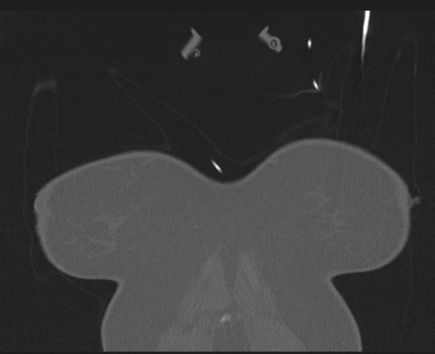 Burst fracture - thoracic spine (Radiopaedia 30238-30865 Coronal bone window 9).jpg
