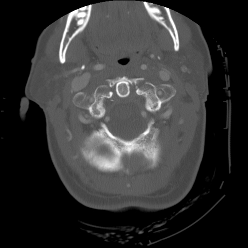 File:C1 anterior arch (plough) fracture - type 1 (Radiopaedia 76181-87720 Axial bone window 30).jpg